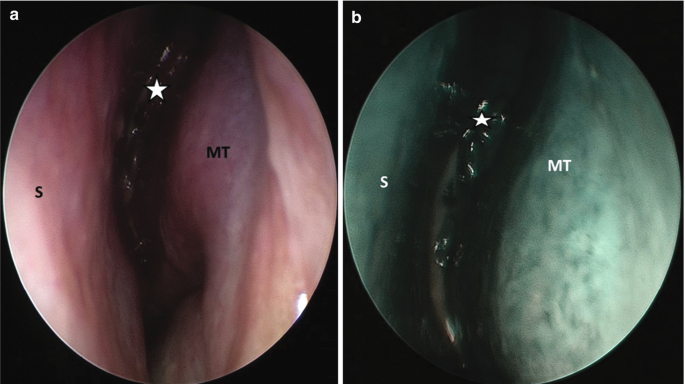 A set of 2 endoscopic images of the nasal cavity. The left portion is marked S and the right portion is marked, M T. The central portion is marked by a star.