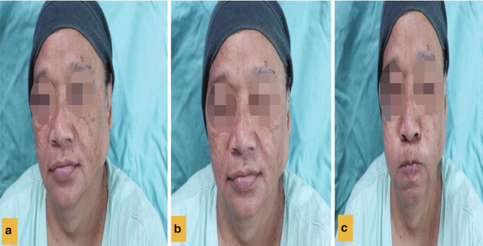 A set of 3 images with the frontal view of the face of a man. In c, the man holds air in his mouth.