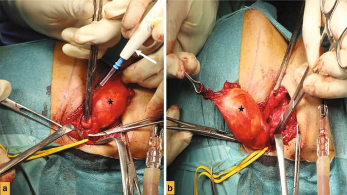 2 images of the neck surgery. In a, the submandibular mass is marked by an arrow and held by forceps. In b, the mass is pulled out with the help of scissors and forceps.