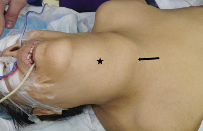 An image of a woman ready for surgery. The frontal neck area is swollen and marked by a star and an arrow.