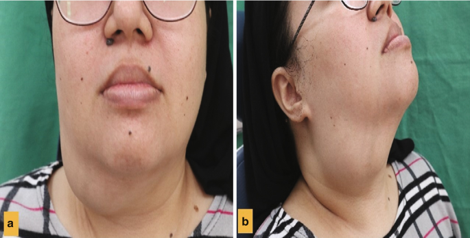 2 images of a woman. A is a frontal view and b is a lateral view. The area below her chin, and above her neck is swollen.