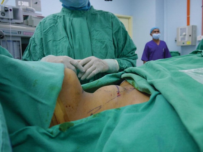 A close-up view of a human neck before surgery with few incision marks on the neck. The face and the rest of the body are covered.