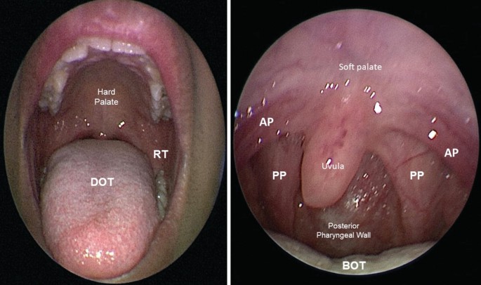 2 close-up views of a human mouth. The labeled parts on the right are the soft palate, anterior and posterior pillar, and so on. The labeled parts on the left are the dorsum of the tongue, hard plate, and retromolar trigone.