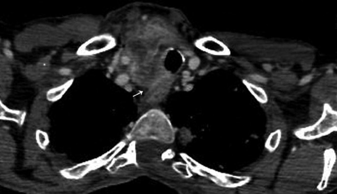 An axial M R I scan of a patient's chest. The arrow on the center marks the effaced fatty tissue.