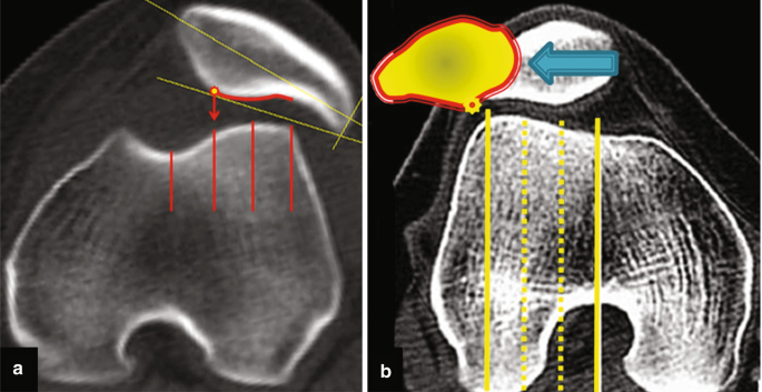 A 2-part computerized tomography of lateral displacement of the patella labeled a and b. A has the lateral facet of the trochlear. It has 4 vertical lines marked on it. B is the lateral displacement of the patella.