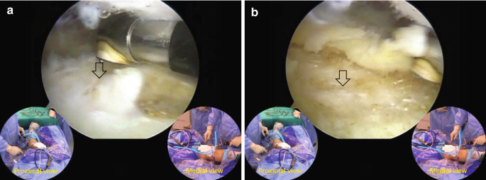 A 2-part image labeled a and b. In part a, an arrow points at the anterior side of the distal femur. In part b, an arrow points at the cartilage at a distal site. Both images have the proximal and medial views on the bottom left and right corners respectively.