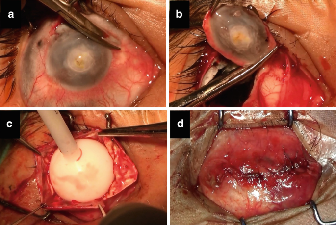 Unsalvageable Eye: Cosmetic Rehabilitation | SpringerLink