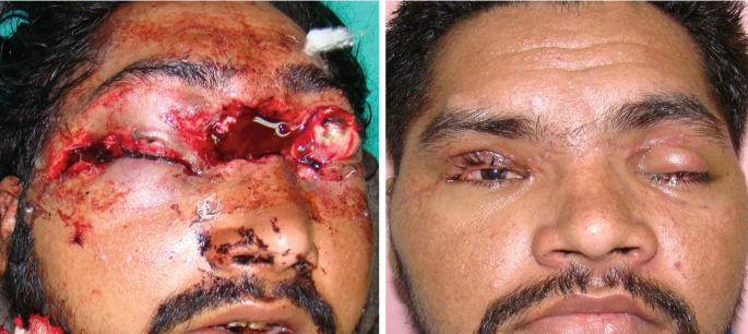 2 photos. A. a close-up view of a man's face with fractured nasal bone between the eyes and both the eye are damaged exposing the blood-filled tissue. B. postoperative view of the face with the half-opened right eye and the left eyelid is swollen with closed eye.