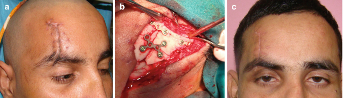 3 photos. A. upper face with a vertical laceration above the right eye. B. a close-up surgical view exposing the plates. C. upper face with vertical sutures mark above the right eye.