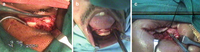 3 photos of close-up views of surgery in the mouth depicting the orbital floor reconstruction with a graft.