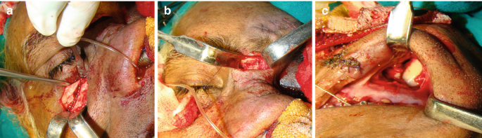 3 photos of the close-up view of the surgery in. A. below the right eye. B. between the 2 eyes. C. Vestibular.