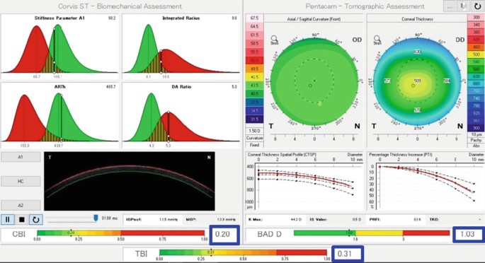 A set of scanned images of Biomechanical parameters and Tomographic images of anterior and posterior elevation, keratometric axial power, and pachymetry.