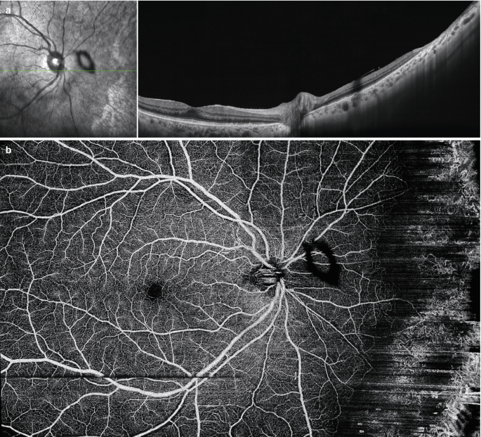 Two S S O C T images. a. A central ring-like bright region is focused next to another ring, and its B-scan image displays thinning of the retina. b. An O C T A montage image displays the Weiss ring near the optic disk.