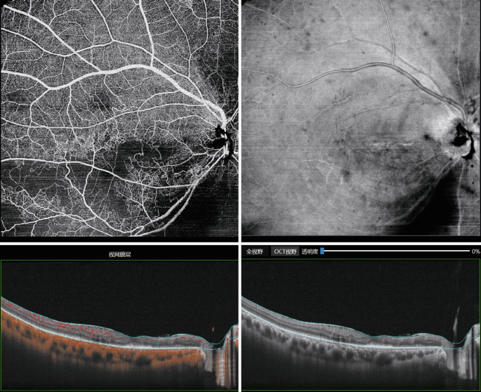 Four O C T A images of the retina. Images 1 and 2 display sparse blood vessels in the inner layer and irregular F A Z. Two B-scans display a disorganized structure in the inner layer of the central fovea with discontinuous ellipsoidal bands.