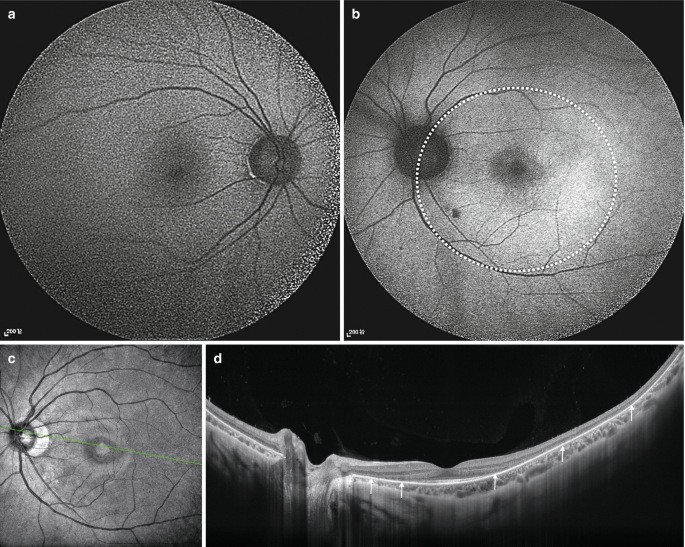 Two fundus autofluorescence images display a dark spot at the center and an enhanced region in the left eye, which is indicated by a dotted circle. Two S S O C T images of the retina, one with a dark spot on the left and several arrows on the right.