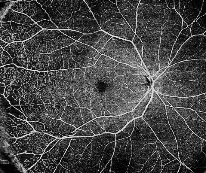 A wide field S S O C T A image with retinal vasculitis in the right eye.