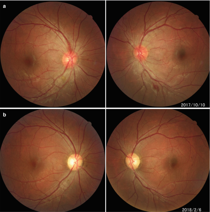 tobacco alcohol optic neuropathy Toxic Optic Neuropathy