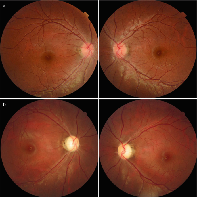 An 18-year-old man with dominant optic atrophy (DOA). The fundus