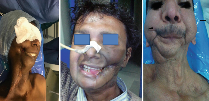 Three images depict the Supraglottic airway devices (S G A D) insertion used in patients with a difficult airway.