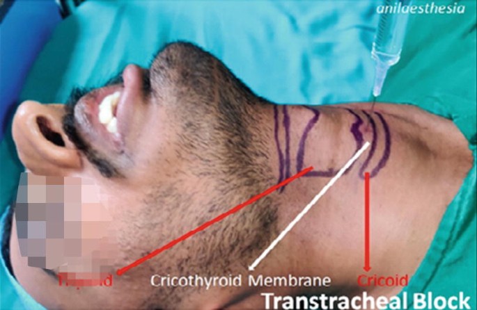 A photograph depicts the marks on a man's neck that exhibit cricothyroid membrane and transtracheal block.