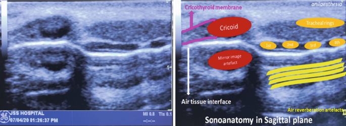 A set of two microscopic images of thin filamentous structures depicts the cricothyroid membrane, mirror image artefact, and air tissue interface of the translaryngeal block.