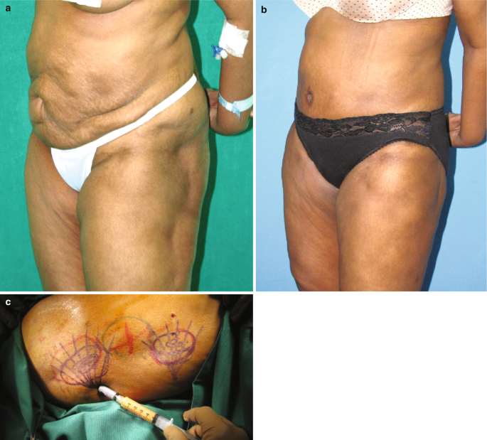 Before & After Lipo of flanks - Dr. Rodriguez, Cosmeticsurg