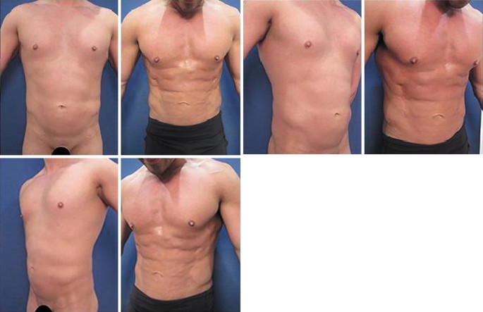 Hi-Def Liposuction in Males and Females