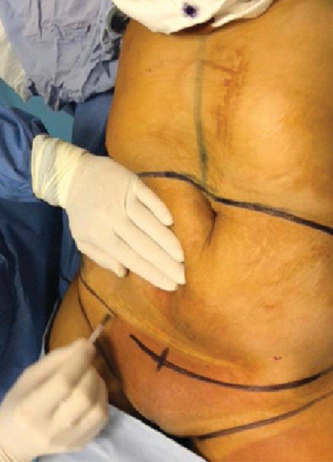 Reverse Abdominoplasty and Inframammary Crease Anchoring - 2 weeks post op  : r/PlasticSurgery