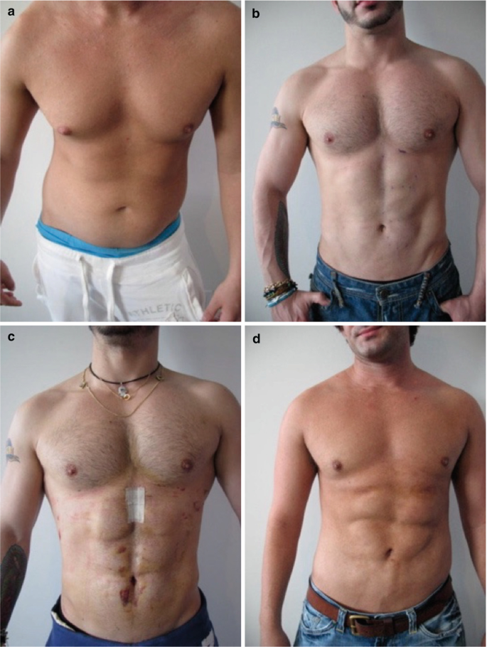 Male Body Contouring with Implants
