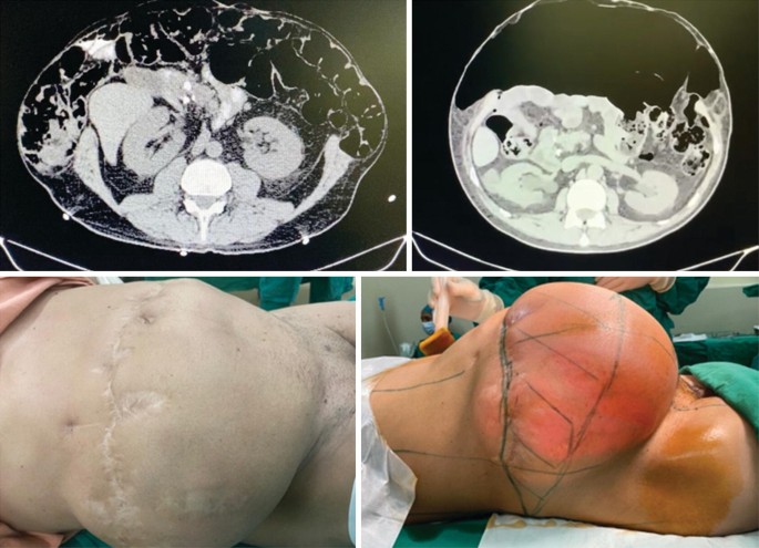 Progressive Pneumoperitoneum (PPP) in Hernia Repair | Springer Nature Link