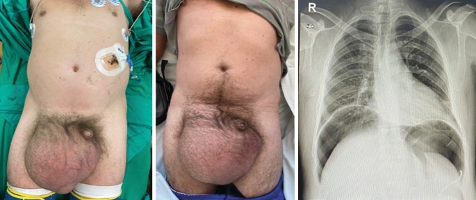 bpc 157 hernia Hiatal Hernia Repair in South Florida