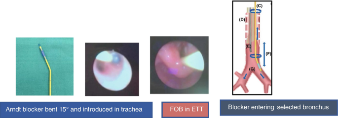 4 photographs of extraluminal blocker placement, labeled by Arndt blocker bent 15 degrees and introduced in the trachea, F O B in E T T, and blocker entering selected bronchus.