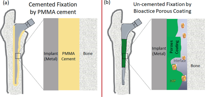 STEM: Press-Fit — Hip & Knee Book