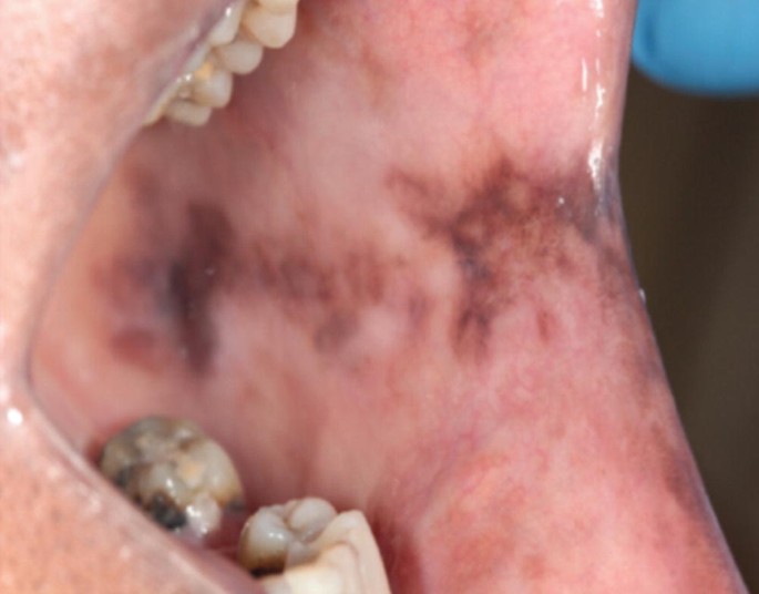 melanotic hyperpigmentation Miscellaneous Hyperpigmentation or Hypermelanosis