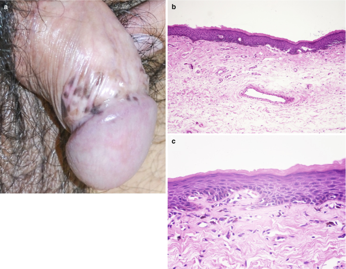 Disorders of Pigmentation of the Nails and Mucous Membranes | Springer  Nature Link