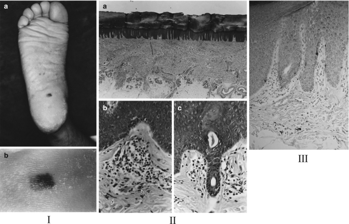 Disorders of Pigmentation of the Nails and Mucous Membranes | Springer  Nature Link