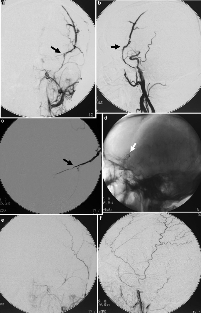 Six scans depict the left internal carotid artery injection, middle meningeal artery, and Onyx cast and scans of a patient with treating pulsatile tinnitus.