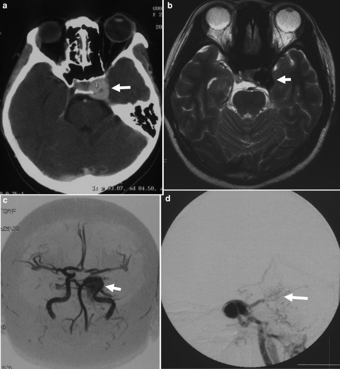 Four scans depict a hyperdensity lesion at the left parasellar location and an engorged left cavernous sinus, scans of a patient with left oculomotor nerve palsy.