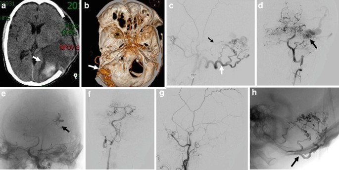 8 scans depict hematoma in the left occipital lobe, a giant venous ectasia of the left occipital lobe, and scans of a patient with intracerebral hematoma.