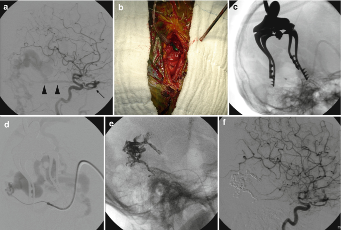 A set of 6 images illustrates a combined surgical-endovascular approach. A, angiogram demonstrating a T D A V F; b, M M A direct puncture; c, craniectomy M M A access, etcetera.