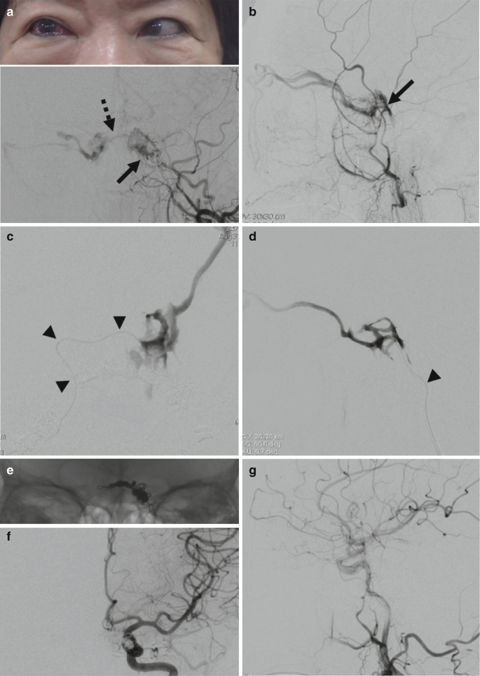 An image of human eyes with the injection of the right. 7 angiogram images depict the contralateral I P S approach to cure d C C F.