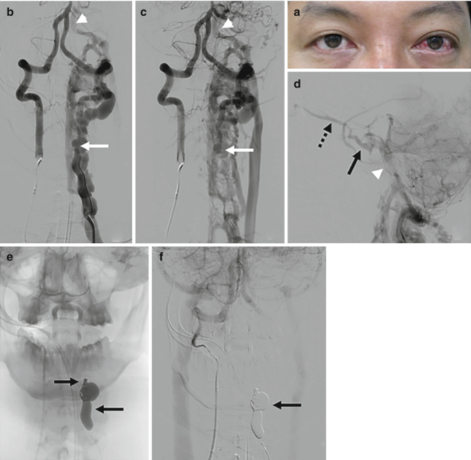 An image of human eyes with left eye proptosis. 5 images depict the stages of vertebro-vertebral fistula with retrograde I P S drainage.