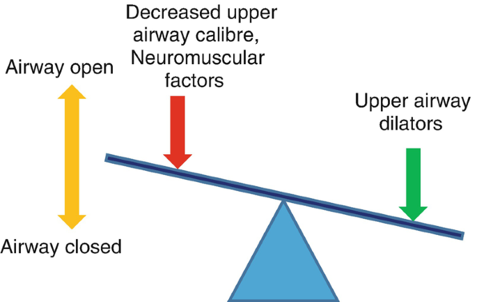 A Seesaw model depicts decreased upper airway calibre, neuromuscular factors, and upper airway dilators at each end. It also depicts the airway opening and closing upward and downward.