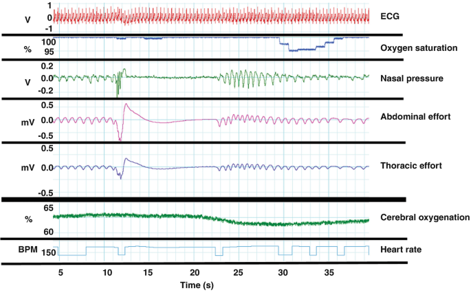 A graph depicts the change in the waveforms with time. These depict ECG, oxygen saturation, nasal pressure, abdominal and thoracic effort, cerebral oxygenation, and heart rate in the form of waves.