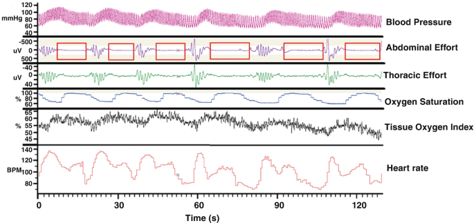 A graph depicts the change in the waveforms with time. These depict blood pressure, abdominal and thoracic effort, oxygen saturation, tissue oxygen index, and heart rate in the form of waves.