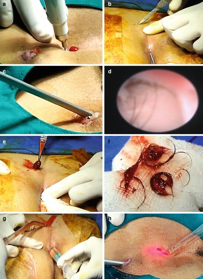 Pilonidal Cyst Cure by Laser has replaced surgery - Laven Clinic