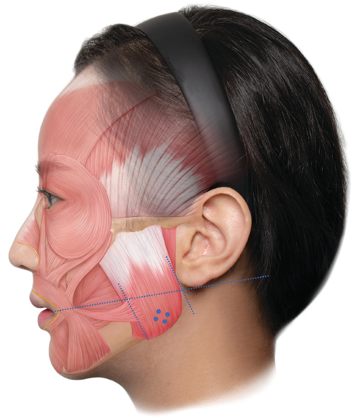 An illustration depicts the 2 layers of the masseter muscle and toxin injection.