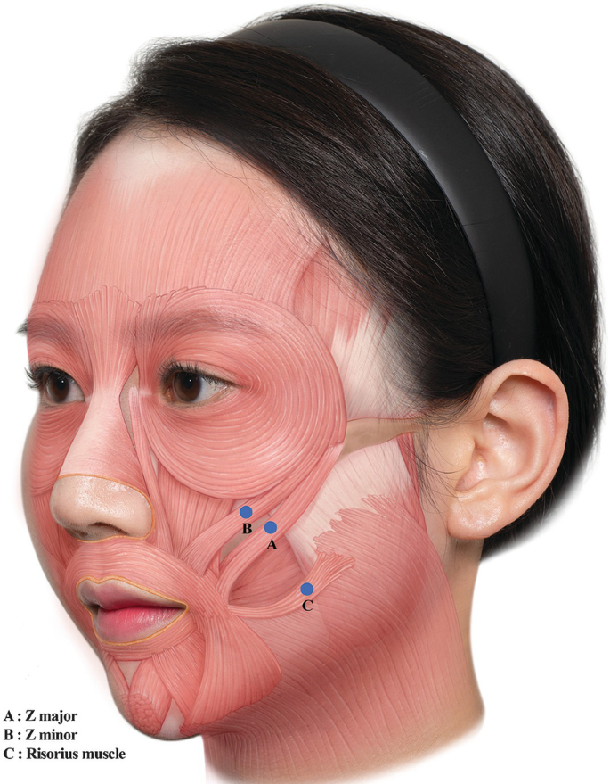An illustration of the lip elevator muscles. The label 3 parts A. Zygomaticus major. B. Zygomaticus minor. C. Risorius muscle.