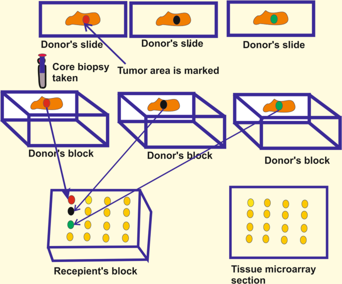 Stepwise construction of a tissue microarray. (A) A paraffin wax core