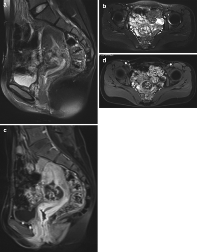 Four M R I scans. Scan A, B, C, and D are of T 2 W 1 underscore F S plus c sagittal, T 1 W 1 underscore F S plus C, T 1 W 1 underscore F S plus C sagittal, and T 1 W 1 underscore F S plus C axial respectively.